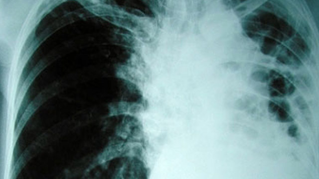 tuberkuloza2