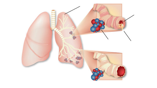 bronhijalna-astma